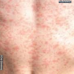 Measles Cases in Kansas May Be Linked to Texas Outbreak 2 Measles Cases in Kansas May Be Linked to Texas Outbreak